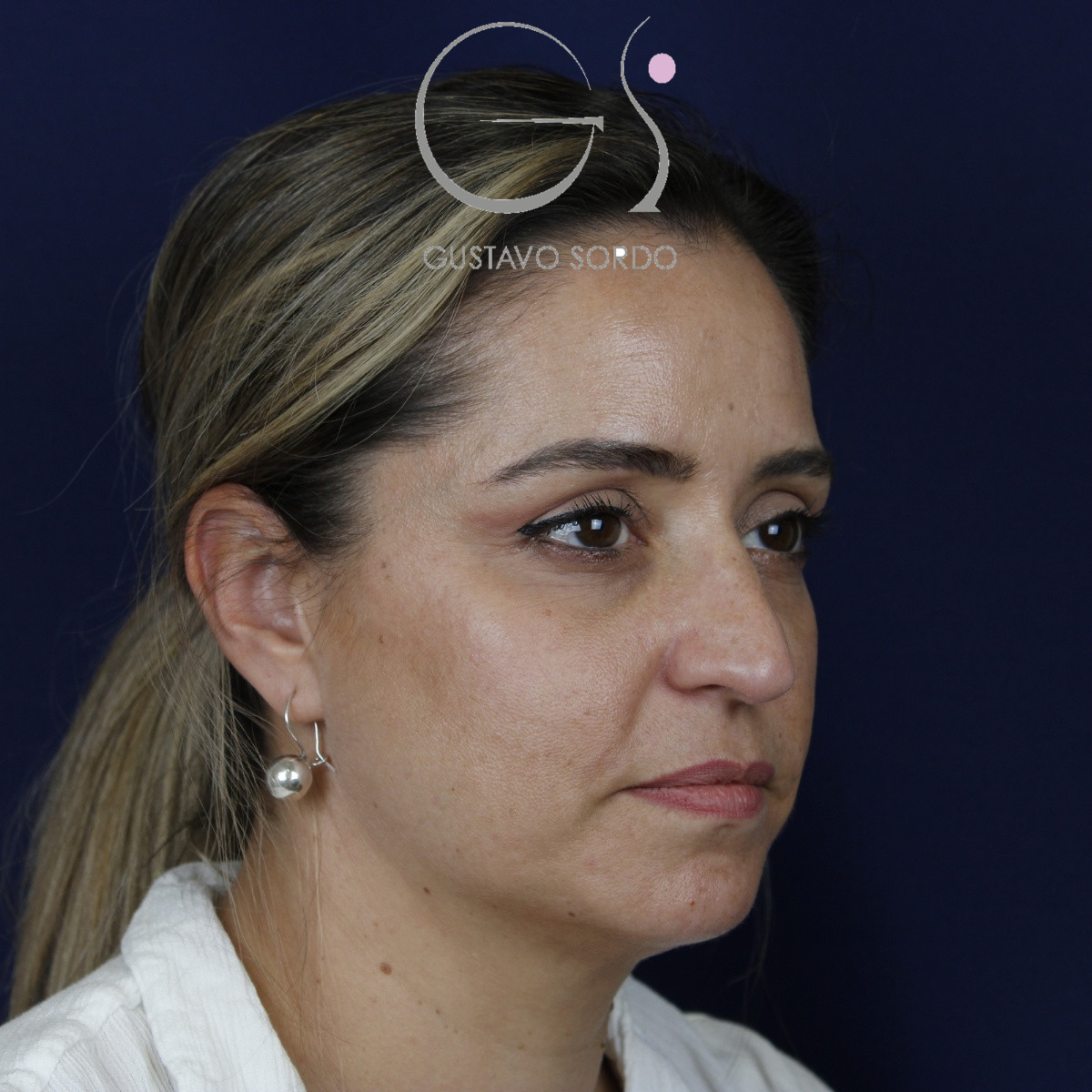Rinoplastia ultrasónica, antes de la cirugía — caso operado por el Dr. Gustavo Sordo en Madrid (6)