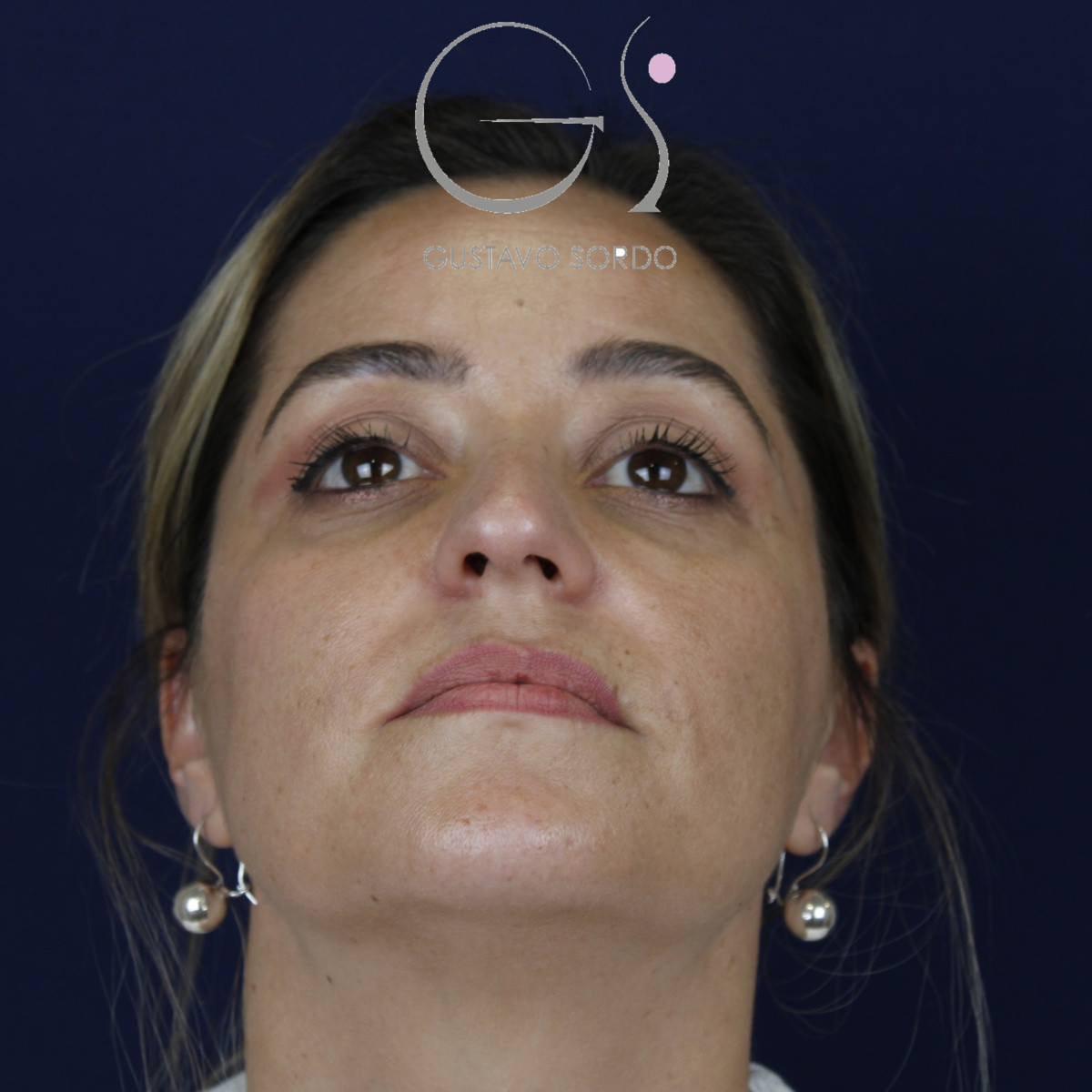 Rinoplastia ultrasónica, antes de la cirugía — caso operado por el Dr. Gustavo Sordo en Madrid (3)
