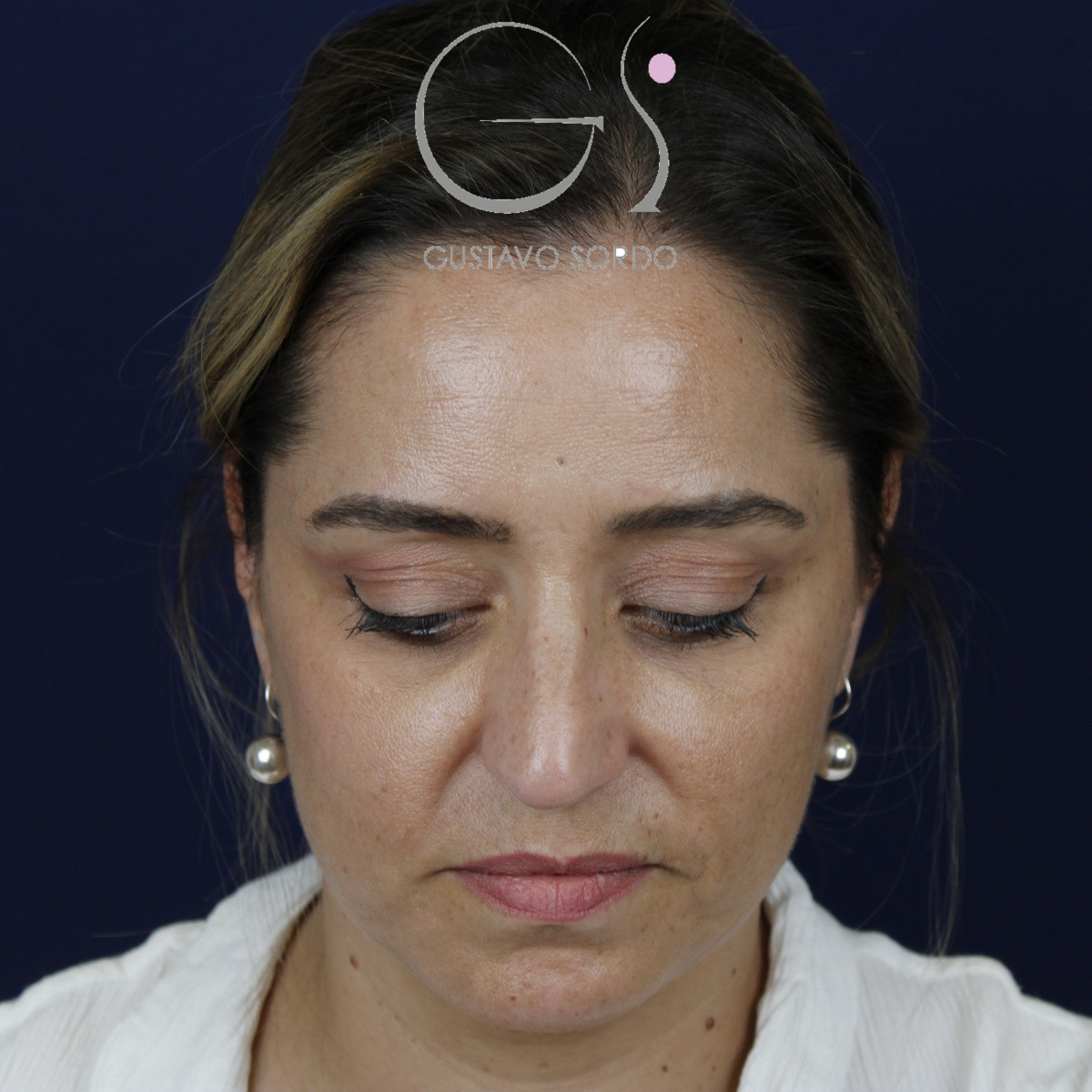 Rinoplastia ultrasónica, antes de la cirugía — caso operado por el Dr. Gustavo Sordo en Madrid (2)