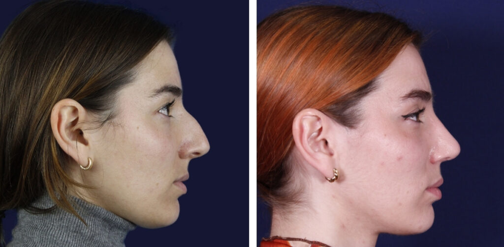 Rinoplastia Abierta o Cerrada Cuál me conviene — Dr. Gustavo Sordo, cirujano plástico en Madrid (3)