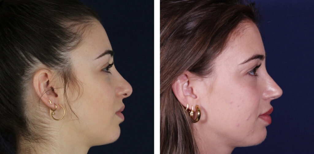 Rinoplastia — Dr. Gustavo Sordo, cirujano plástico en Madrid (2)