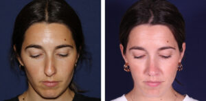 Rinoplastia — tabique desviado en Madrid