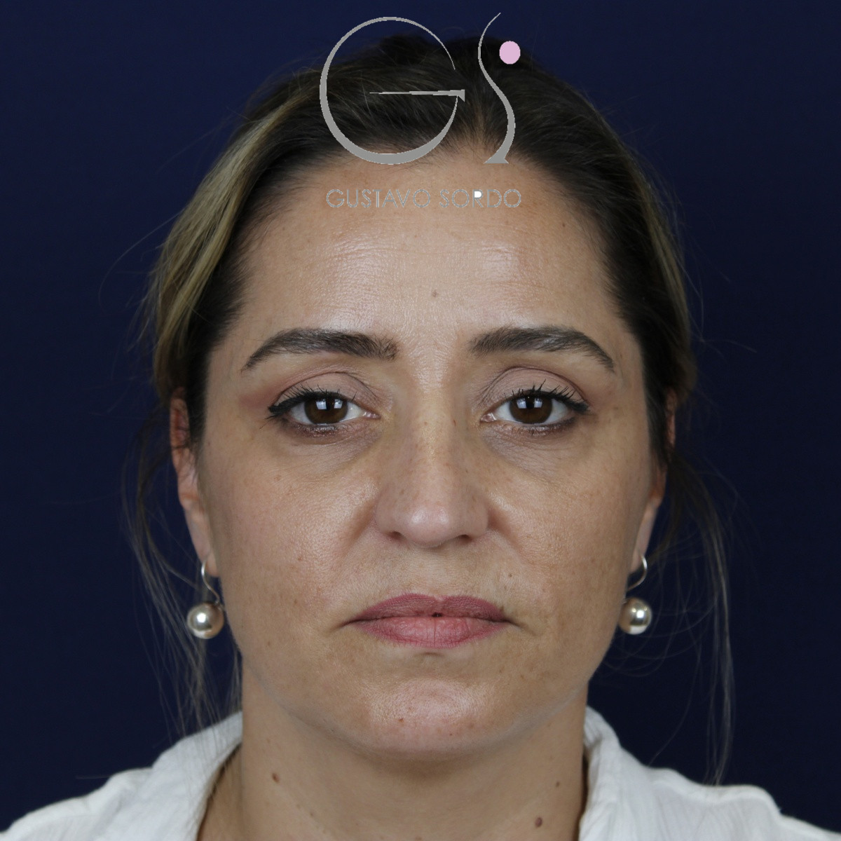 Rinoplastia ultrasónica, antes de la cirugía — caso operado por el Dr. Gustavo Sordo en Madrid (1)