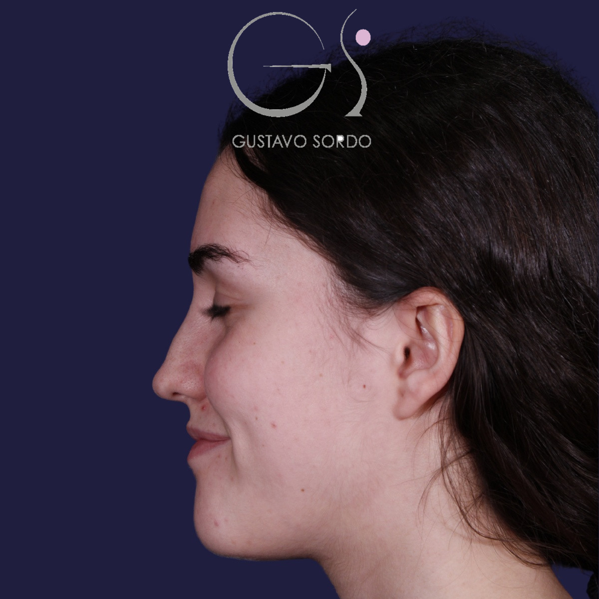 Rinoplastia postraumática de nariz en silla de montar con injerto costal, antes de la operación (6)