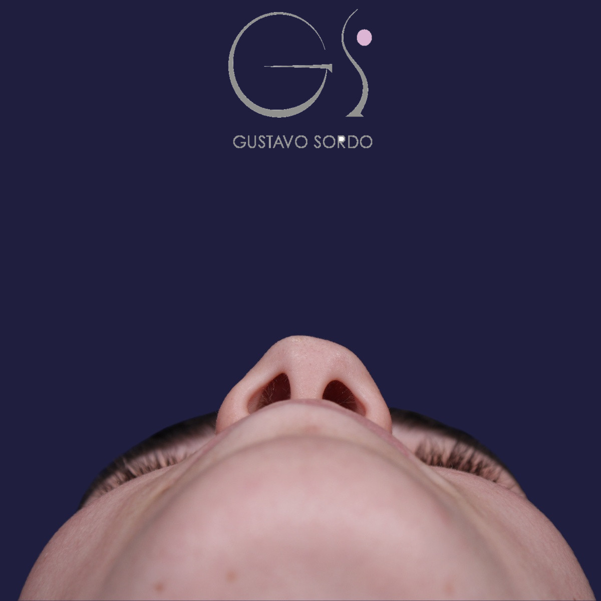 Rinoplastia postraumática de nariz en silla de montar con injerto costal, antes de la operación (4)