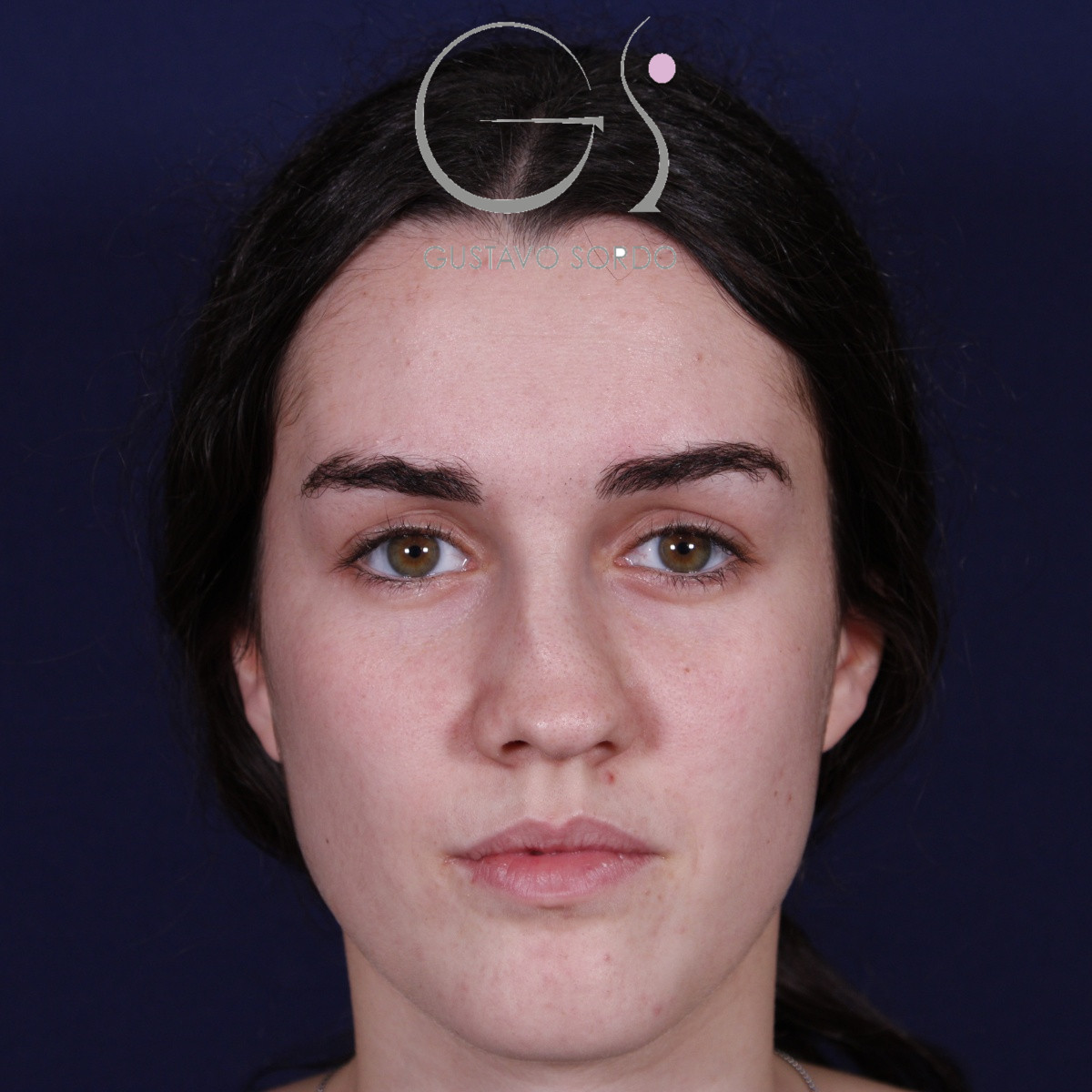 Rinoplastia postraumática de nariz en silla de montar con injerto costal, antes de la operación (1)