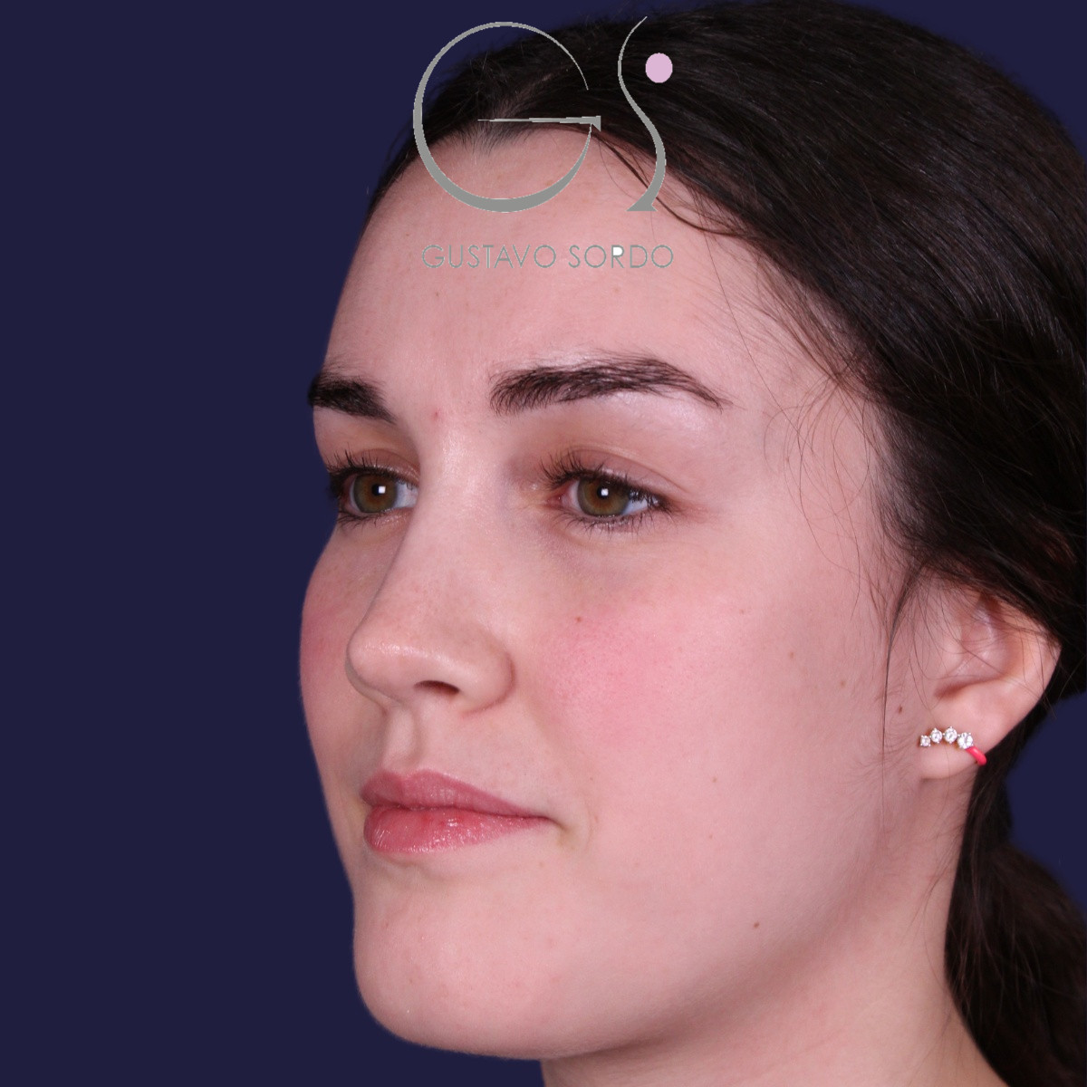 Rinoplastia postraumática de nariz en silla de montar con injerto costal, después de la operación (8)