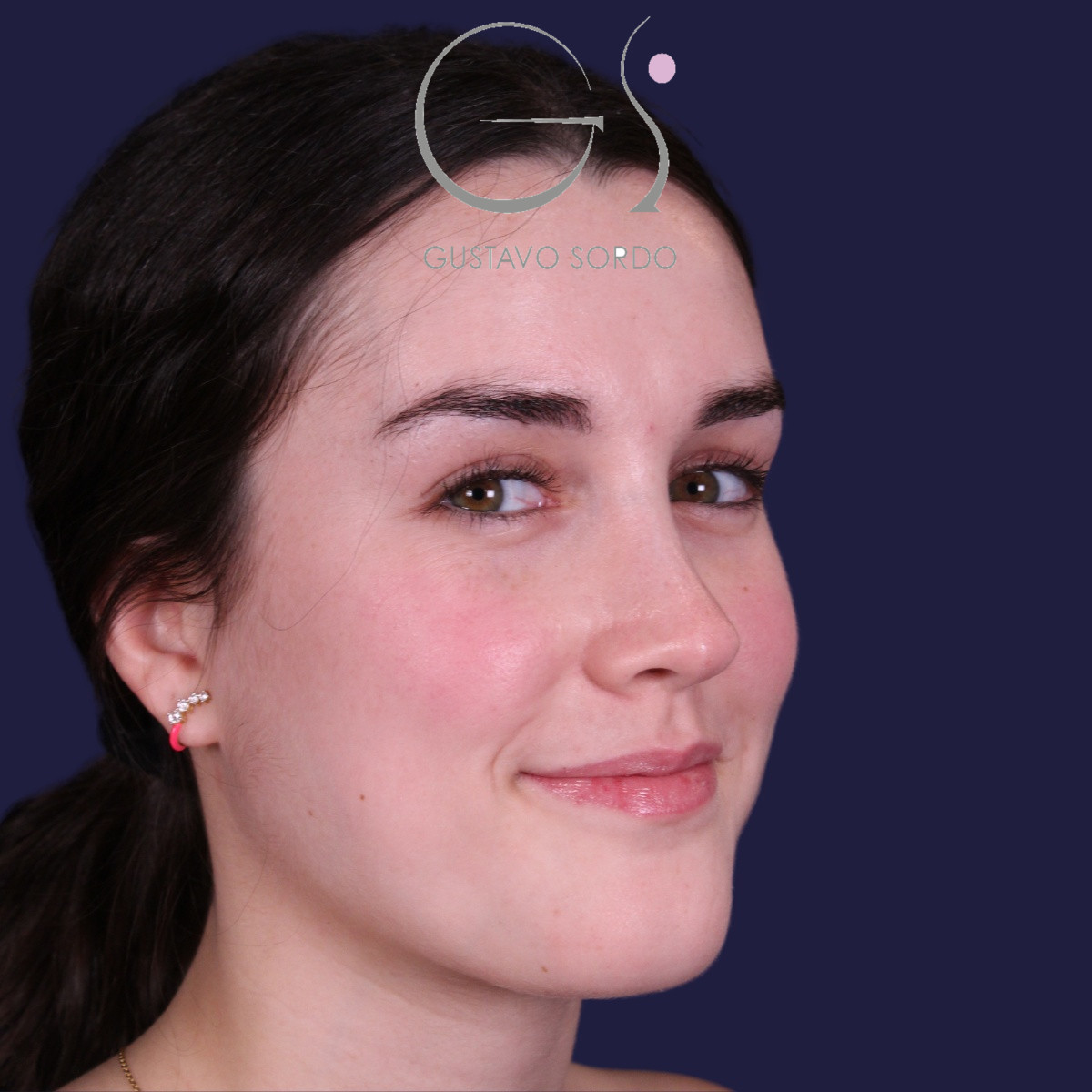 Rinoplastia postraumática de nariz en silla de montar con injerto costal, después de la operación (7)