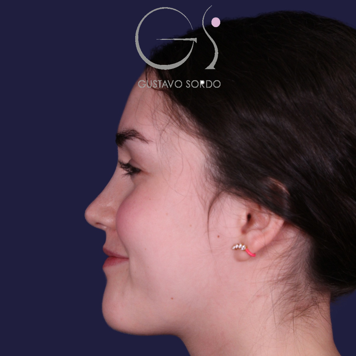 Rinoplastia postraumática de nariz en silla de montar con injerto costal, después de la operación (6)