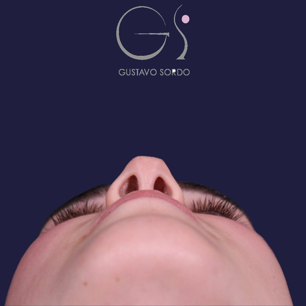 Rinoplastia postraumática de nariz en silla de montar con injerto costal, después de la operación (4)