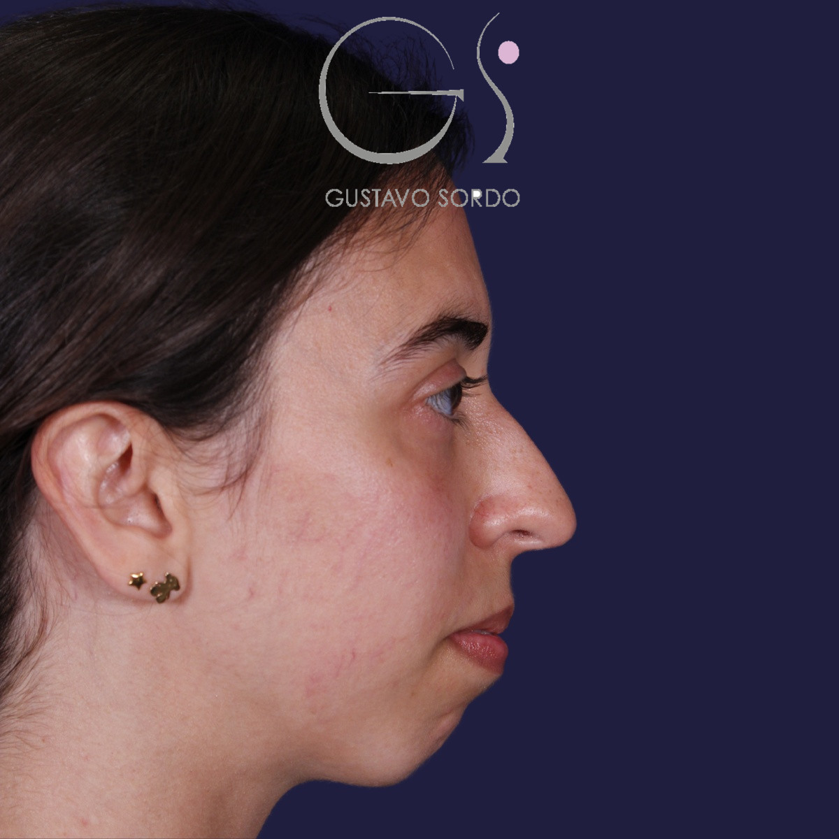 Rinoplastia, antes de la cirugía — caso operado por el Dr. Gustavo Sordo en Madrid (5)