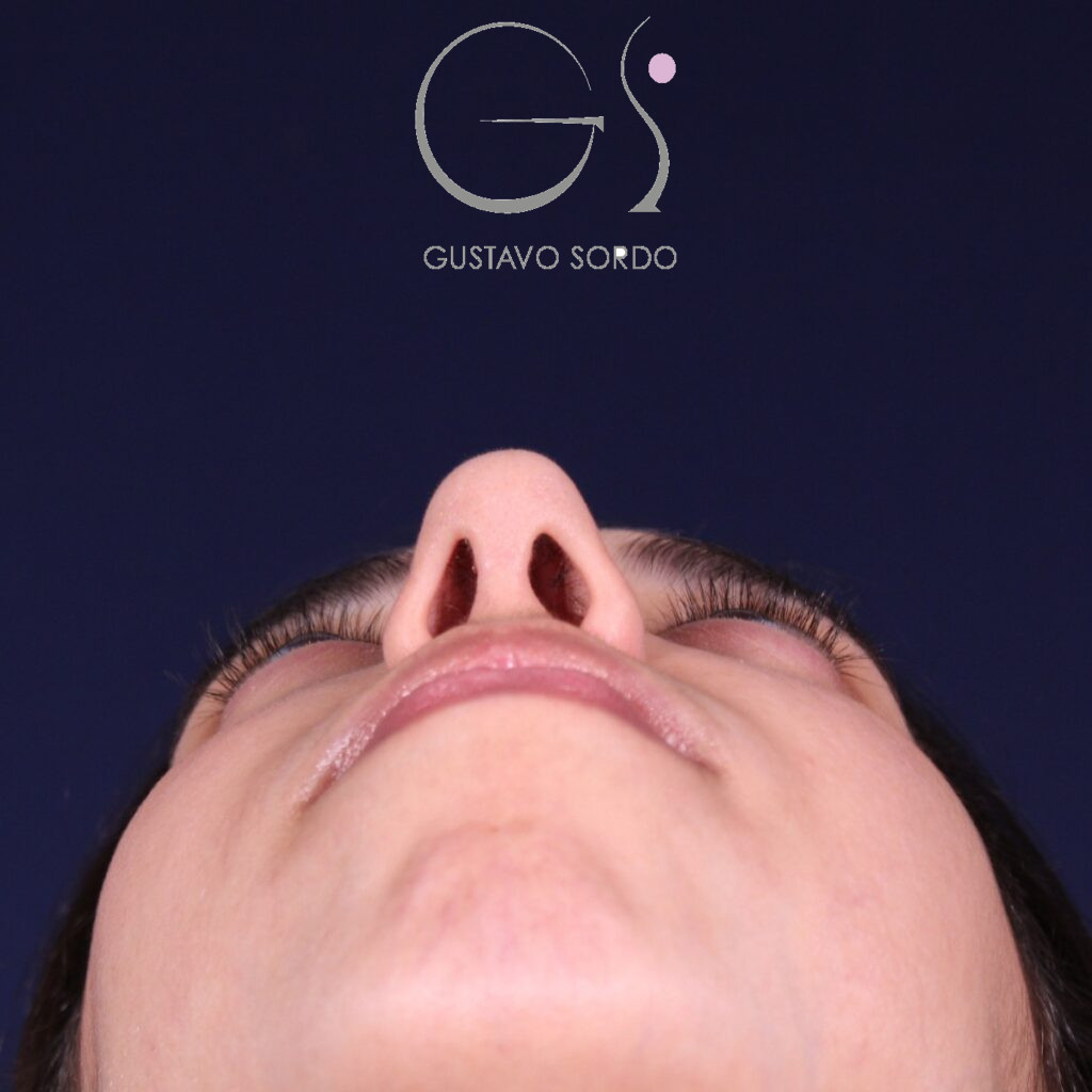 Rinoplastia, resultado tras la cirugía — caso operado por el Dr. Gustavo Sordo en Madrid (4)