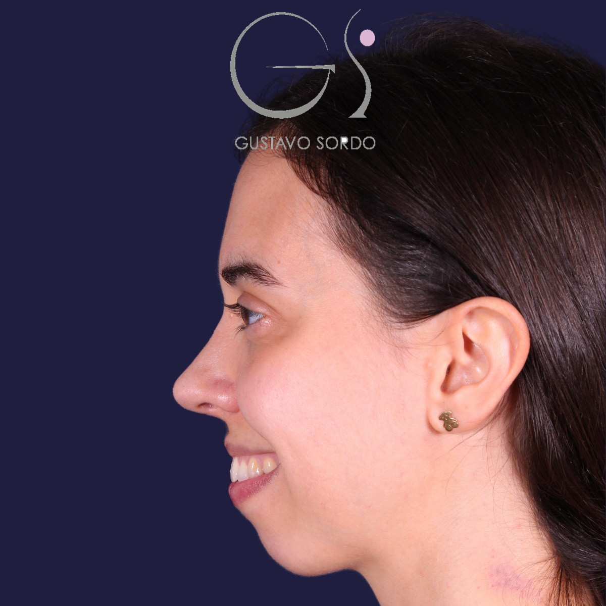 Rinoplastia, resultado tras la cirugía — caso operado por el Dr. Gustavo Sordo en Madrid (6)