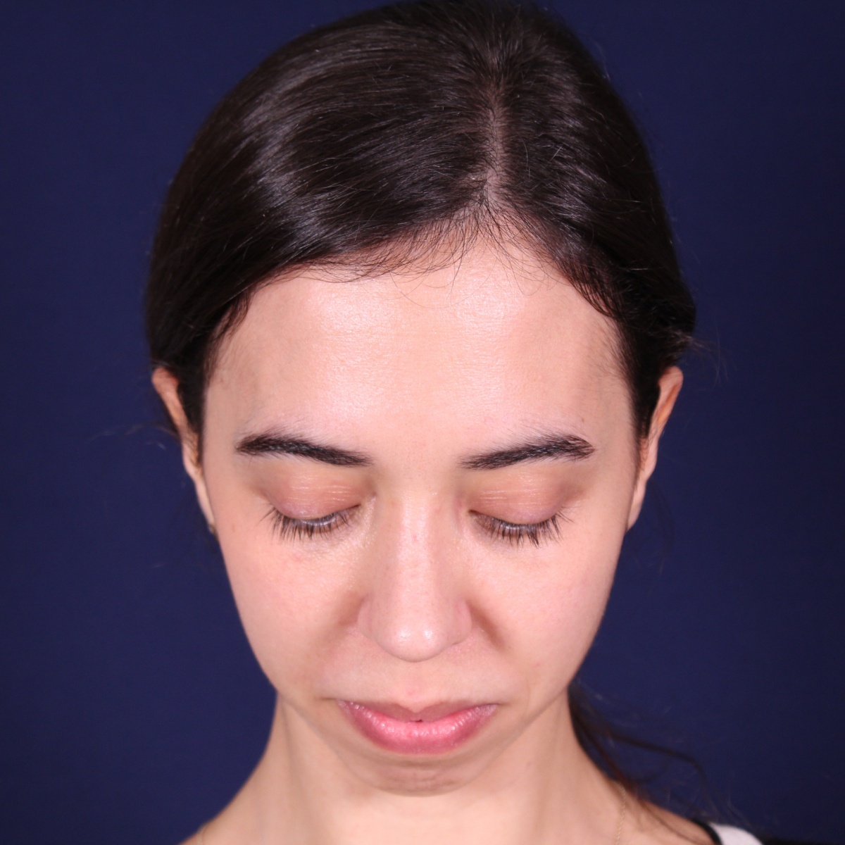 Rinoplastia, resultado tras la cirugía — caso operado por el Dr. Gustavo Sordo en Madrid (2)