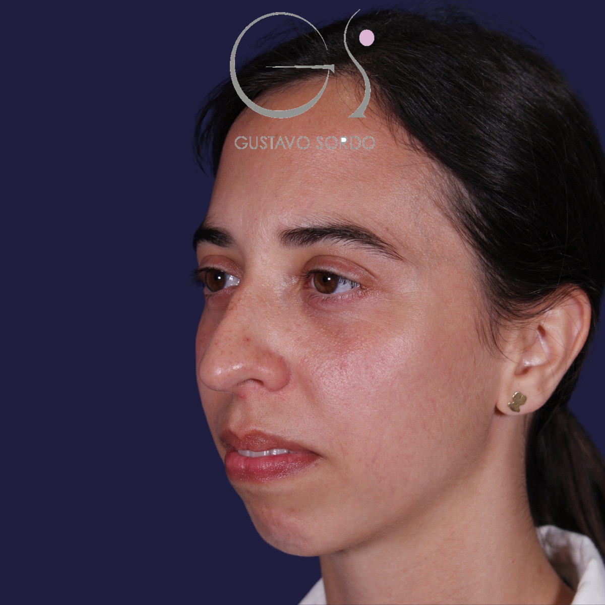 Rinoplastia, antes de la cirugía — caso operado por el Dr. Gustavo Sordo en Madrid (8)