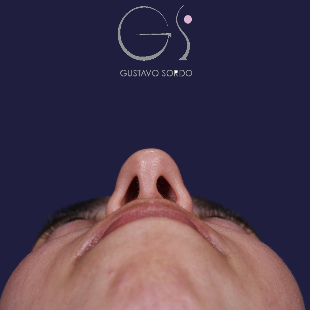 Rinoplastia, antes de la cirugía — caso operado por el Dr. Gustavo Sordo en Madrid (4)