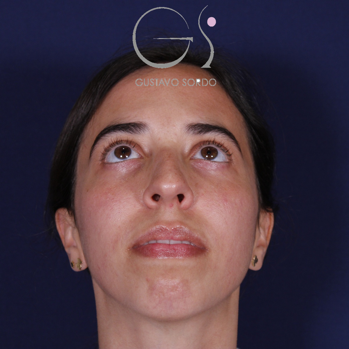 Rinoplastia, antes de la cirugía — caso operado por el Dr. Gustavo Sordo en Madrid (3)