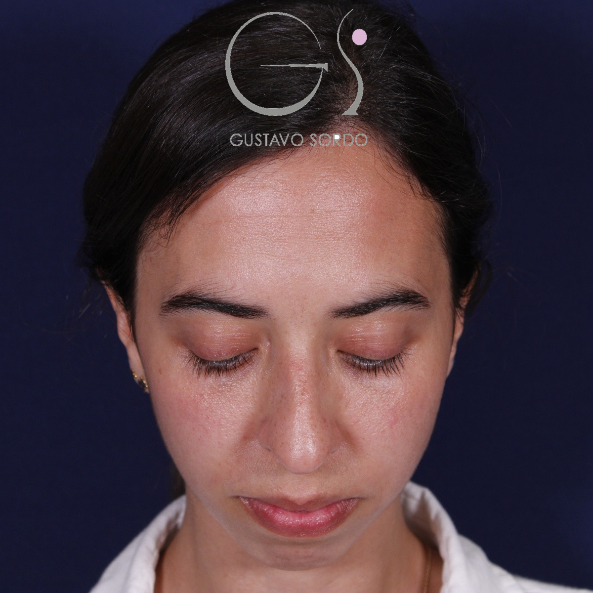 Rinoplastia, antes de la cirugía — caso operado por el Dr. Gustavo Sordo en Madrid (2)
