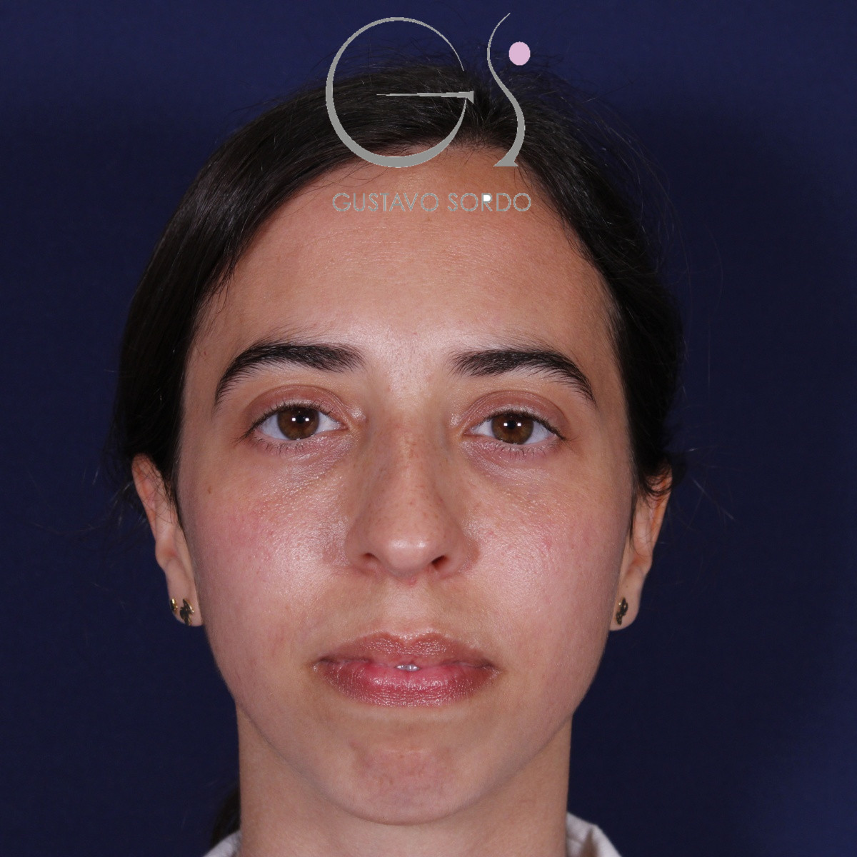 Rinoplastia, antes de la cirugía — caso operado por el Dr. Gustavo Sordo en Madrid (1)