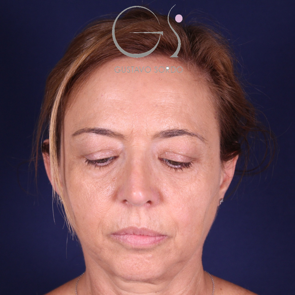 Rinoplastia, resultado tras la cirugía — caso operado por el Dr. Gustavo Sordo en Madrid (2)