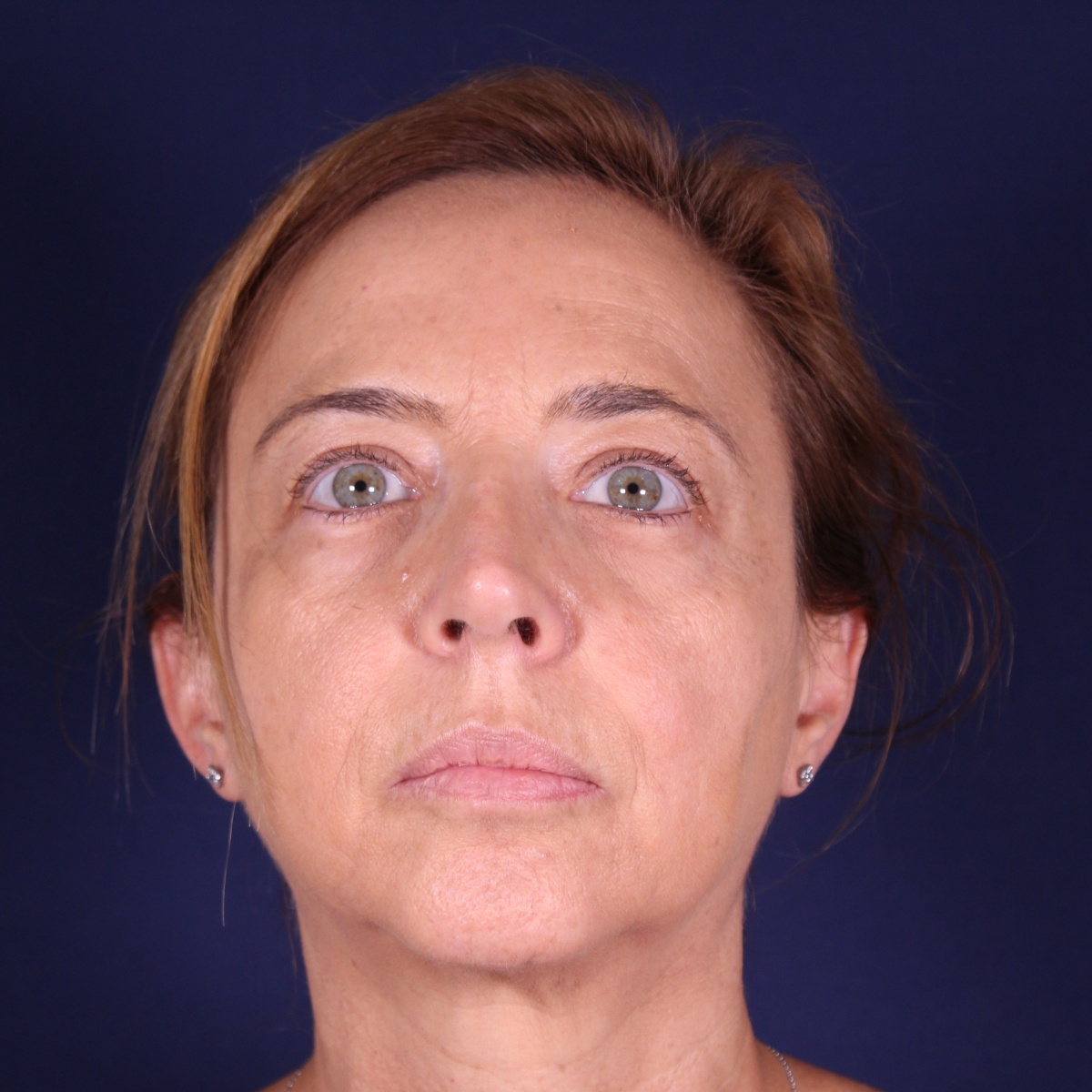 Rinoplastia, resultado tras la cirugía — caso operado por el Dr. Gustavo Sordo en Madrid (1)