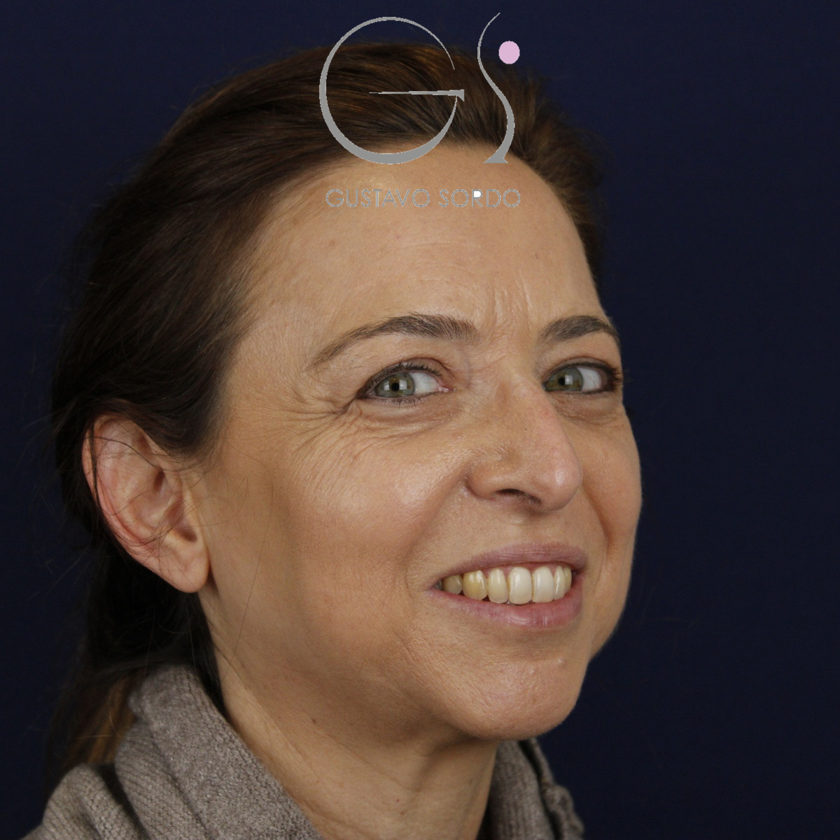 Rinoplastia, antes de la cirugía — caso operado por el Dr. Gustavo Sordo en Madrid (6)