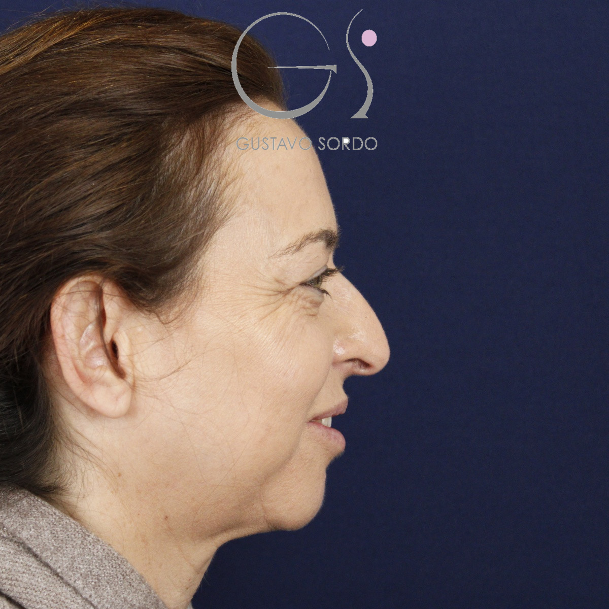 Rinoplastia, antes de la cirugía — caso operado por el Dr. Gustavo Sordo en Madrid (4)