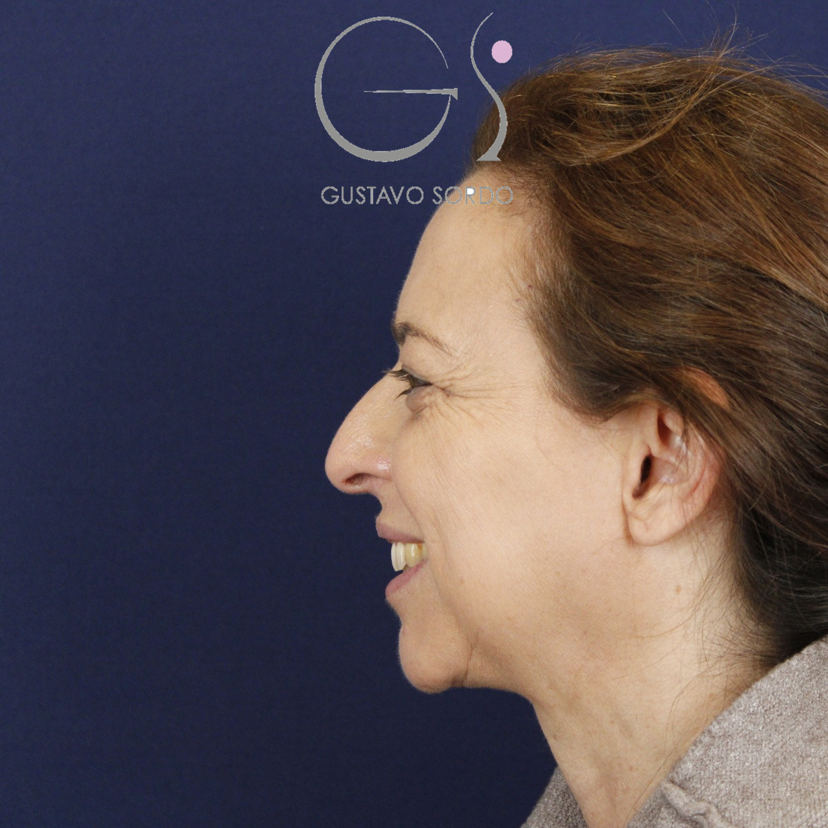 Rinoplastia, antes de la cirugía — caso operado por el Dr. Gustavo Sordo en Madrid (3)