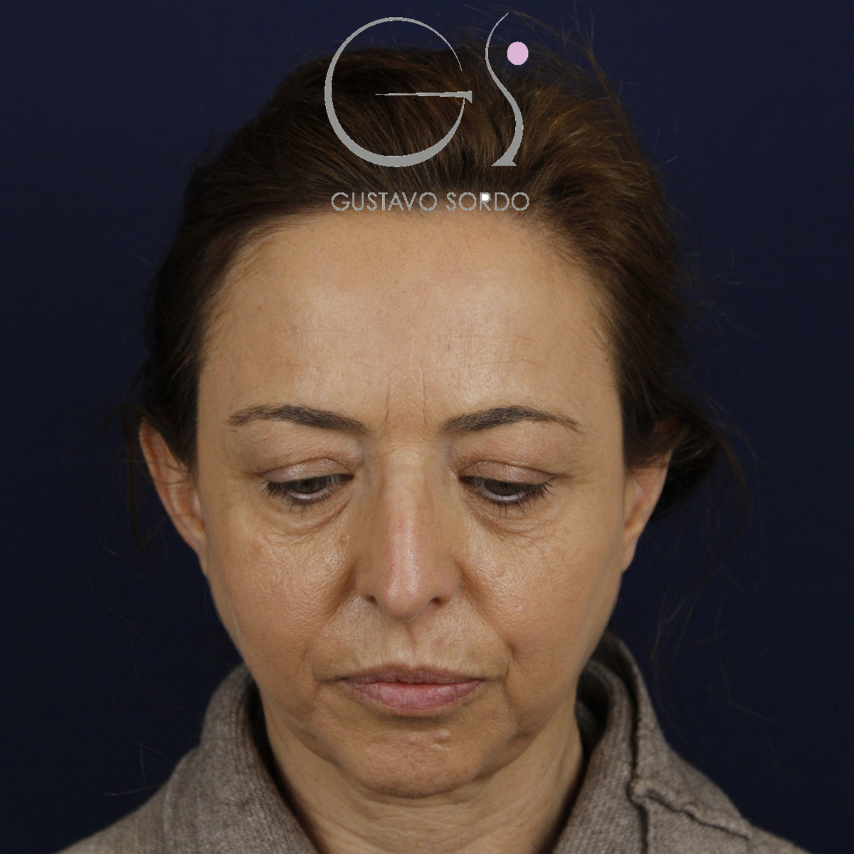 Rinoplastia, antes de la cirugía — caso operado por el Dr. Gustavo Sordo en Madrid (2)