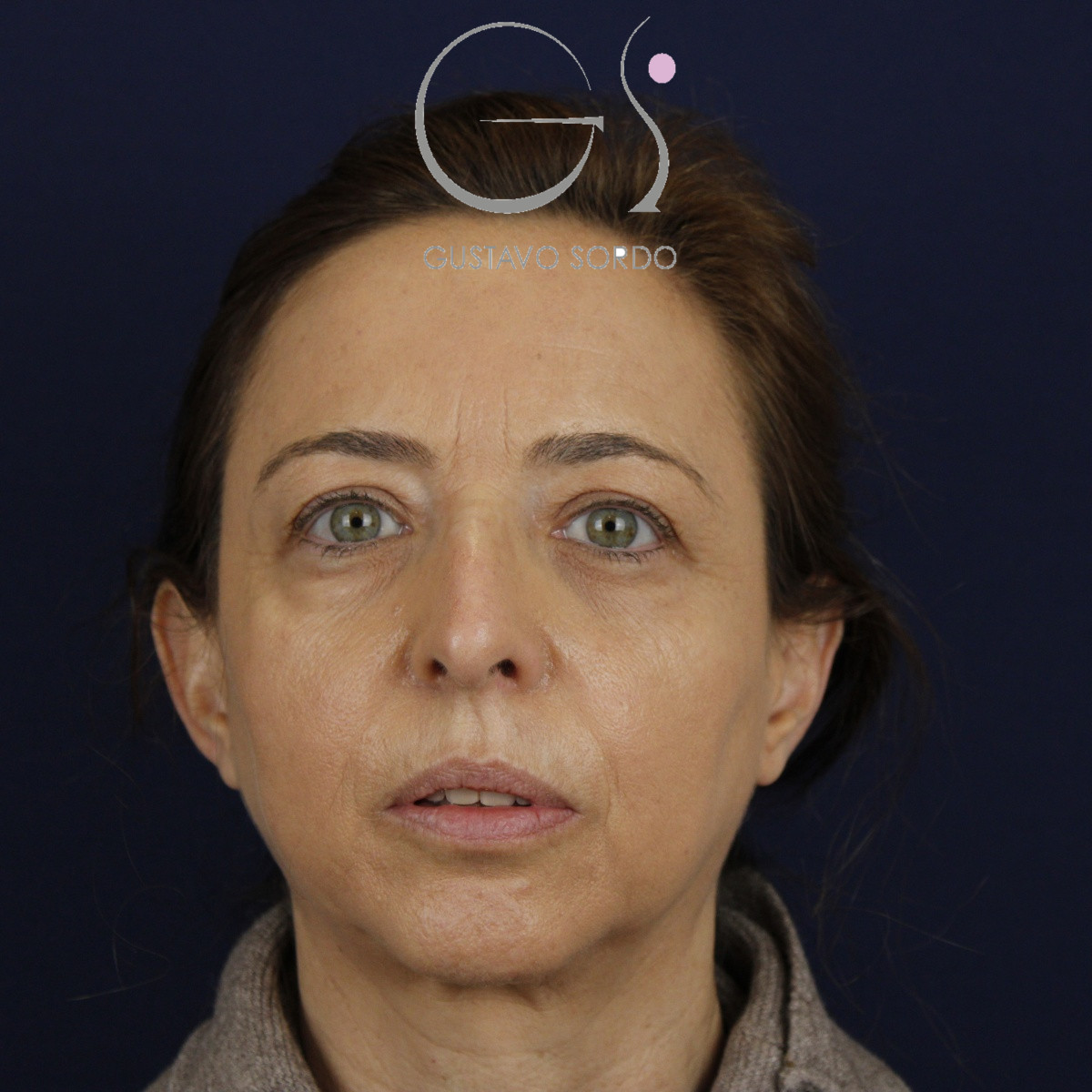 Rinoplastia, antes de la cirugía — caso operado por el Dr. Gustavo Sordo en Madrid (1)