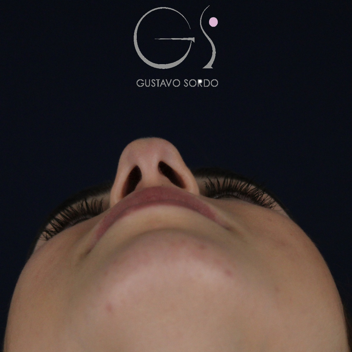 Rinoplastia, antes de la cirugía — caso operado por el Dr. Gustavo Sordo en Madrid (4)