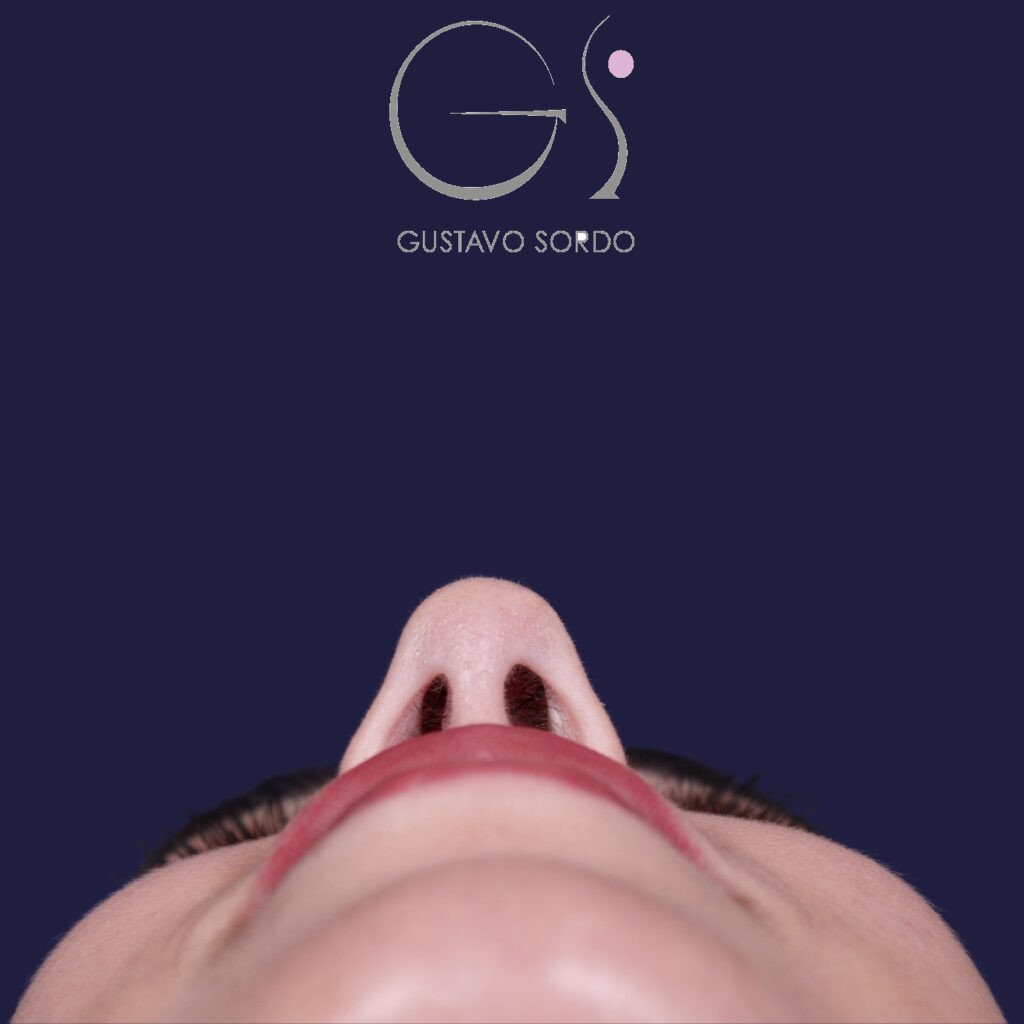 Rinoplastia, resultado tras la cirugía — caso operado por el Dr. Gustavo Sordo en Madrid (4)