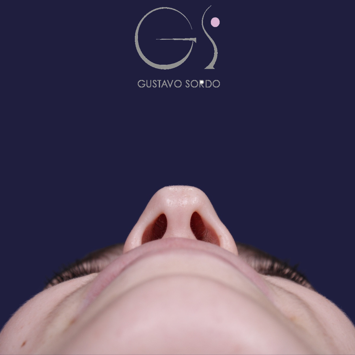Rhinoplastie : avant et après une intervention réalisée par le Dr Gustavo Sordo à Madrid