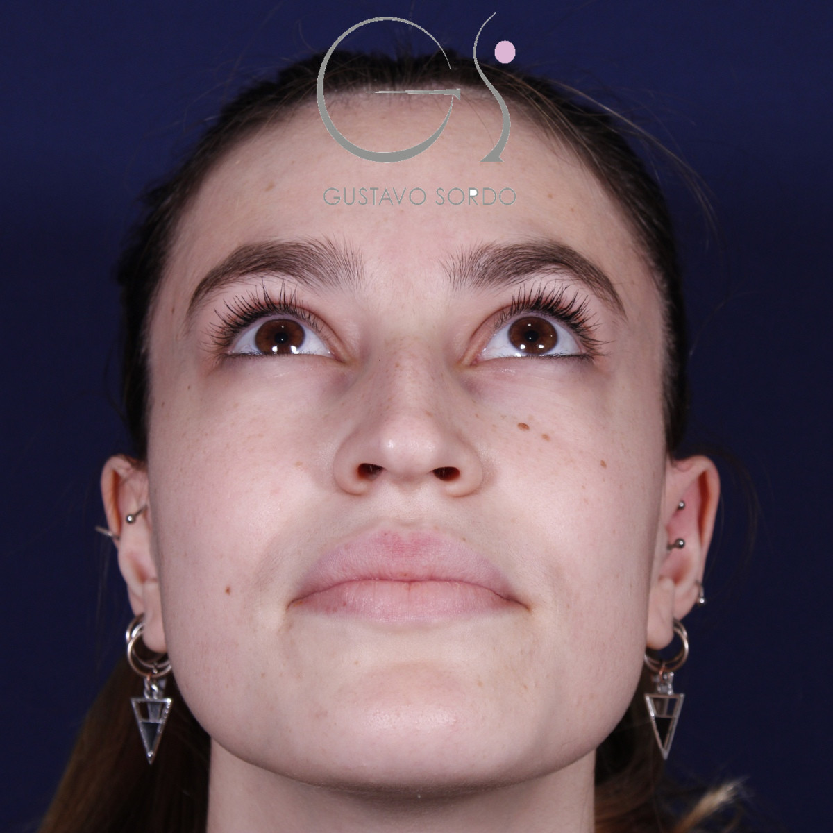 Rhinoplastie : avant et après une intervention réalisée par le Dr Gustavo Sordo à Madrid
