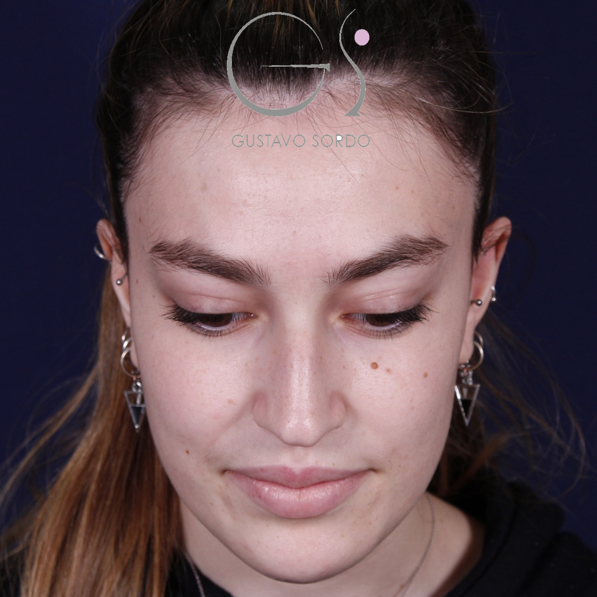 Rhinoplastie : avant et après une intervention réalisée par le Dr Gustavo Sordo à Madrid