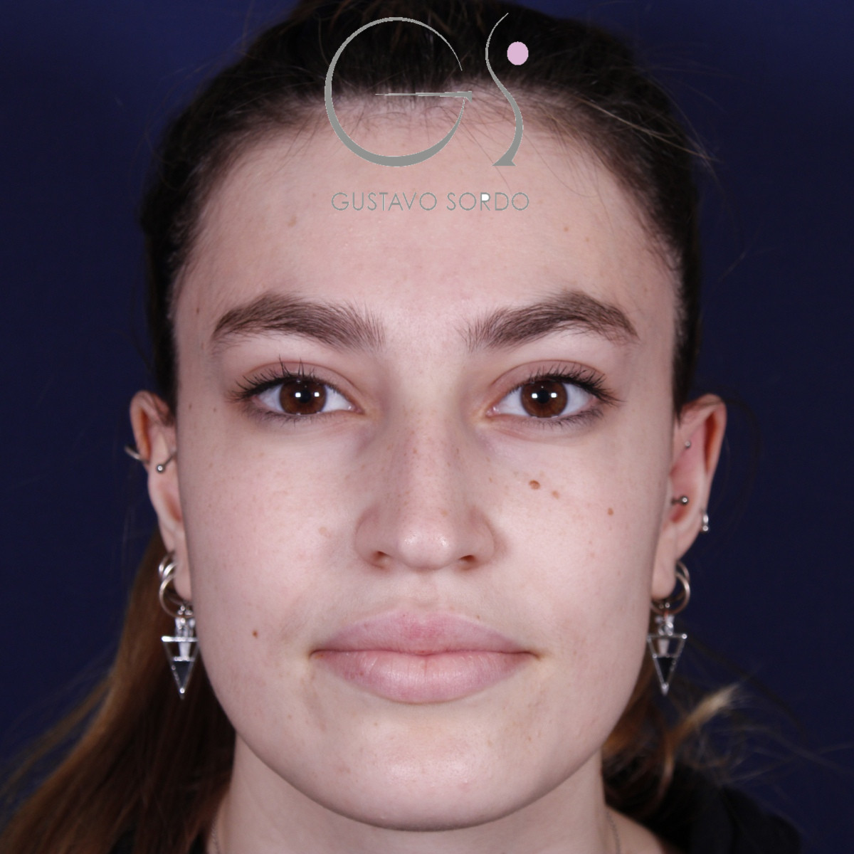 Rhinoplastie : avant et après une intervention réalisée par le Dr Gustavo Sordo à Madrid