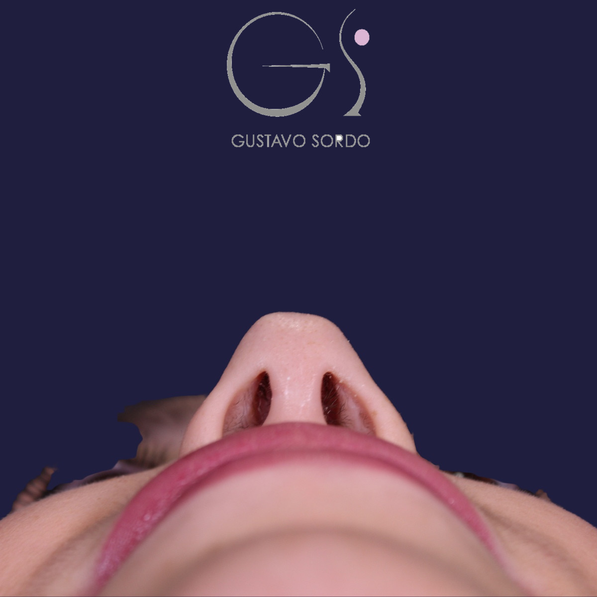 Rhinoplastie : avant et après une intervention réalisée par le Dr Gustavo Sordo à Madrid