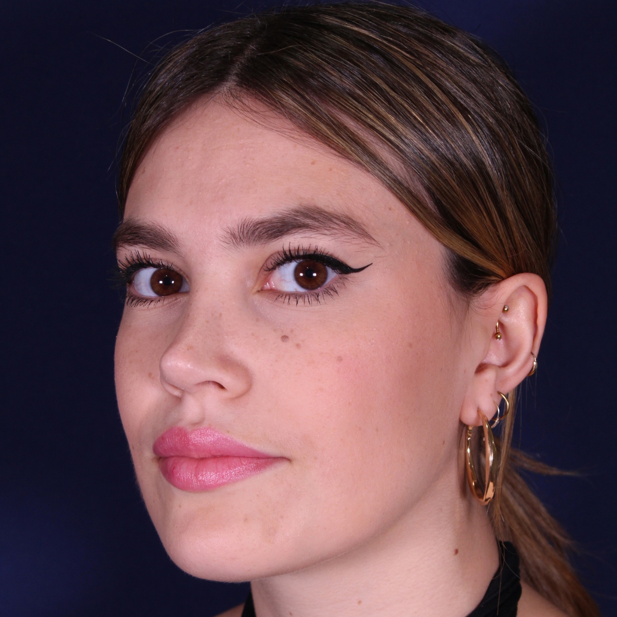 Rhinoplastie : avant et après une intervention réalisée par le Dr Gustavo Sordo à Madrid