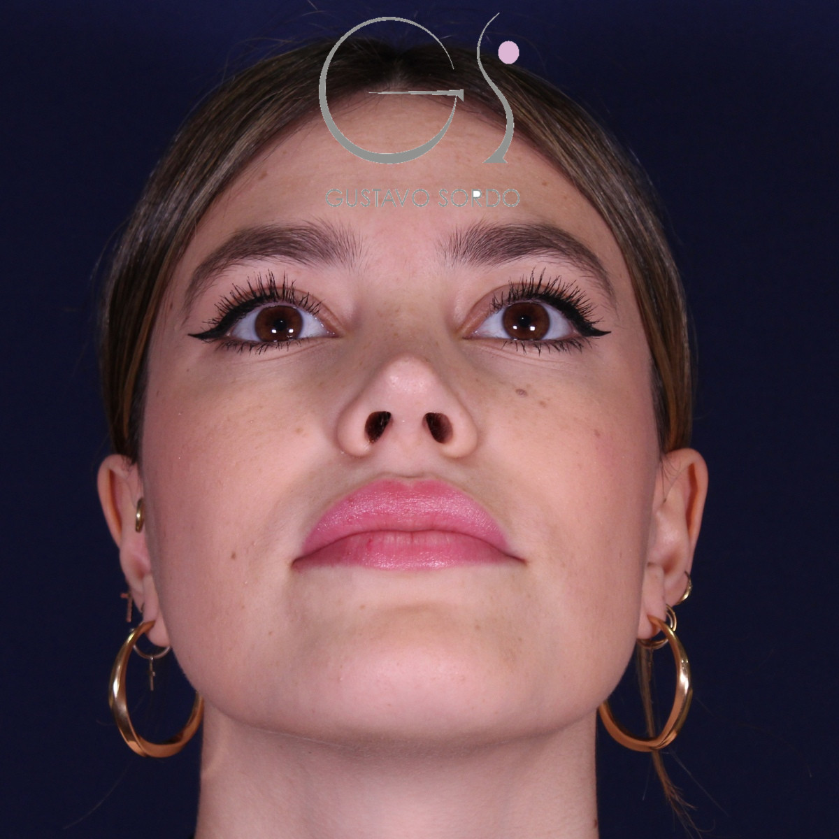 Rhinoplastie : avant et après une intervention réalisée par le Dr Gustavo Sordo à Madrid