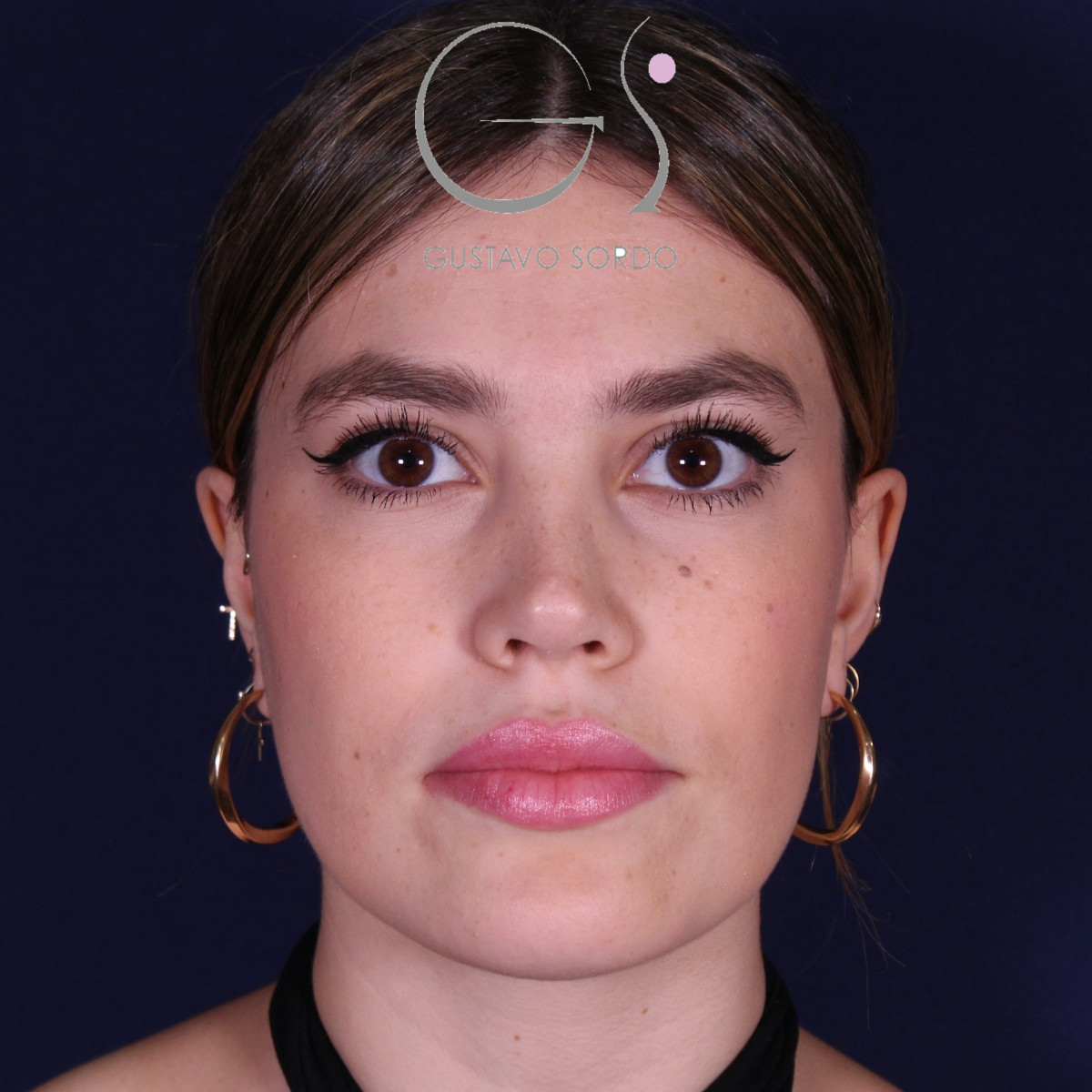 Rhinoplastie : avant et après une intervention réalisée par le Dr Gustavo Sordo à Madrid