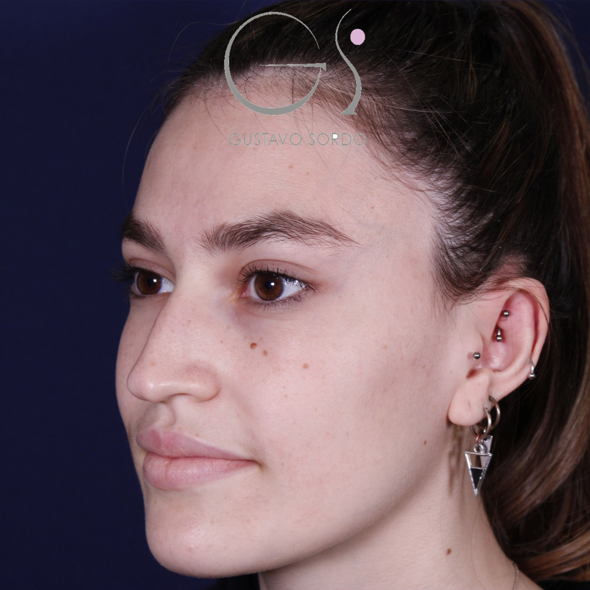 Rhinoplastie : avant et après une intervention réalisée par le Dr Gustavo Sordo à Madrid