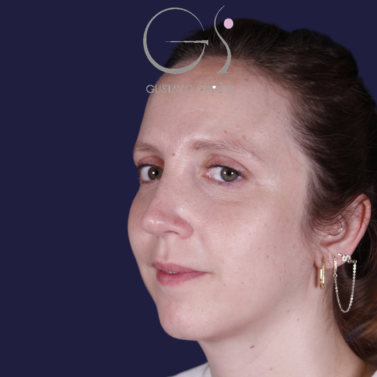 Rinoplastia ultrasónica realizada en paciente joven — después. Caso operado por el Dr. Gustavo Sordo en Madrid