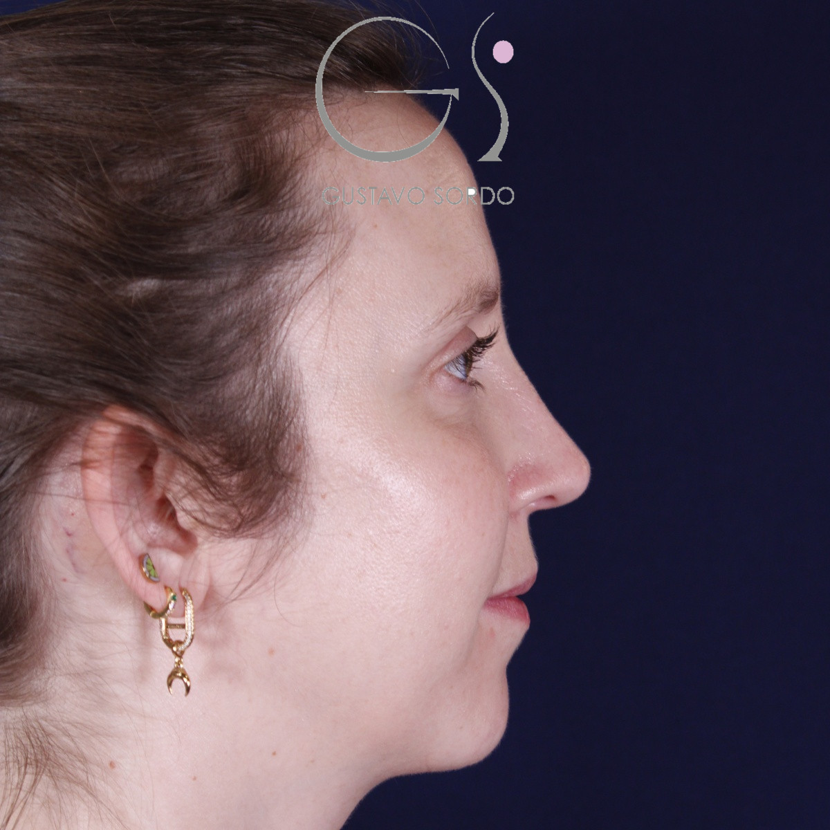 Rinoplastia ultrasónica realizada en paciente joven — después. Caso operado por el Dr. Gustavo Sordo en Madrid