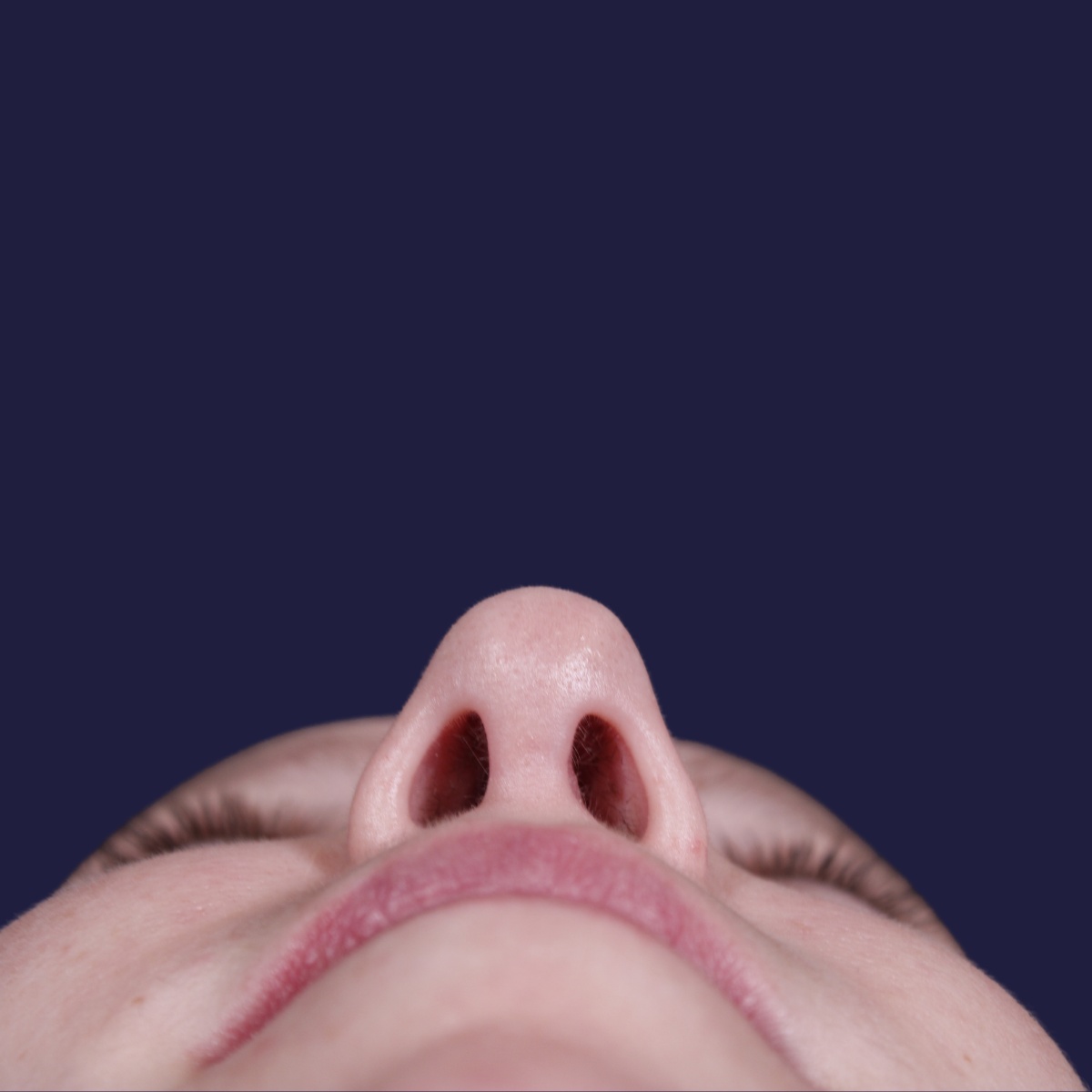 Rinoplastia ultrasónica realizada en paciente joven — después. Caso operado por el Dr. Gustavo Sordo en Madrid
