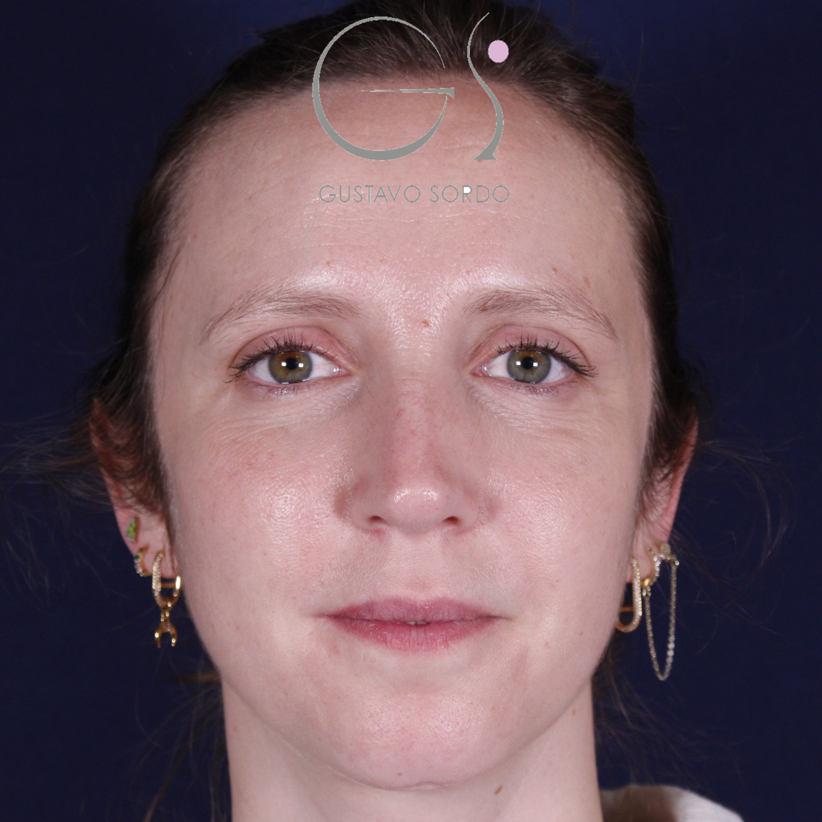 Rinoplastia ultrasónica realizada en paciente joven — después. Caso operado por el Dr. Gustavo Sordo en Madrid