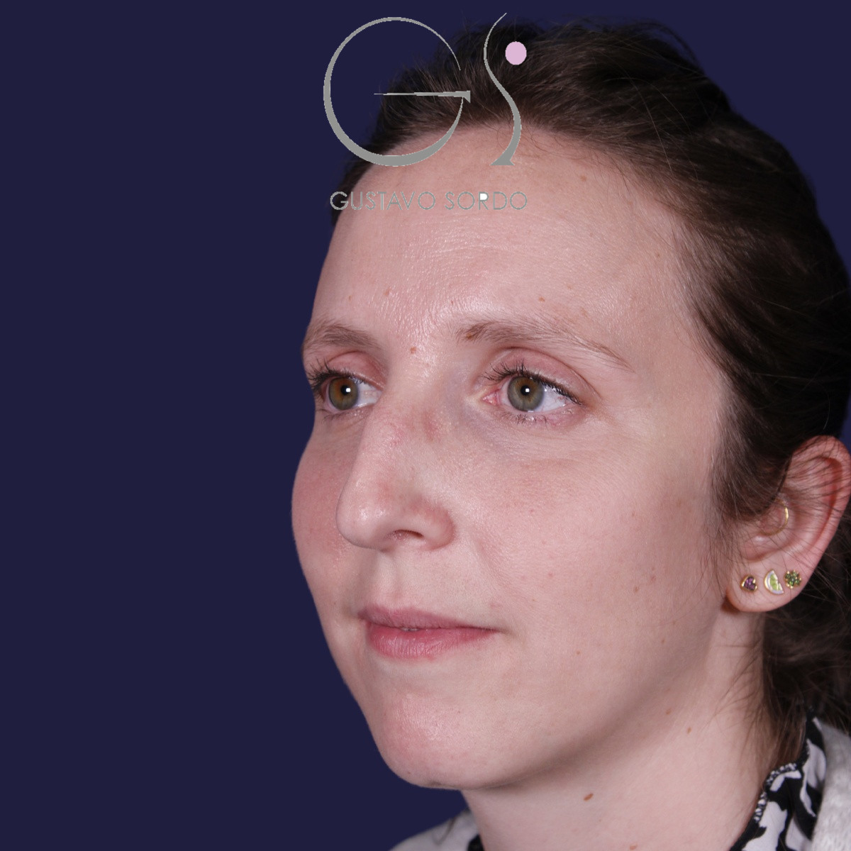 Rinoplastia ultrasónica realizada en paciente joven — antes. Caso operado por el Dr. Gustavo Sordo en Madrid