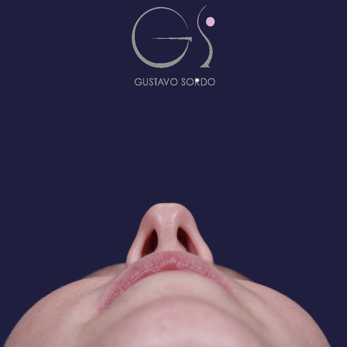 Rinoplastia ultrasónica realizada en paciente joven — antes. Caso operado por el Dr. Gustavo Sordo en Madrid