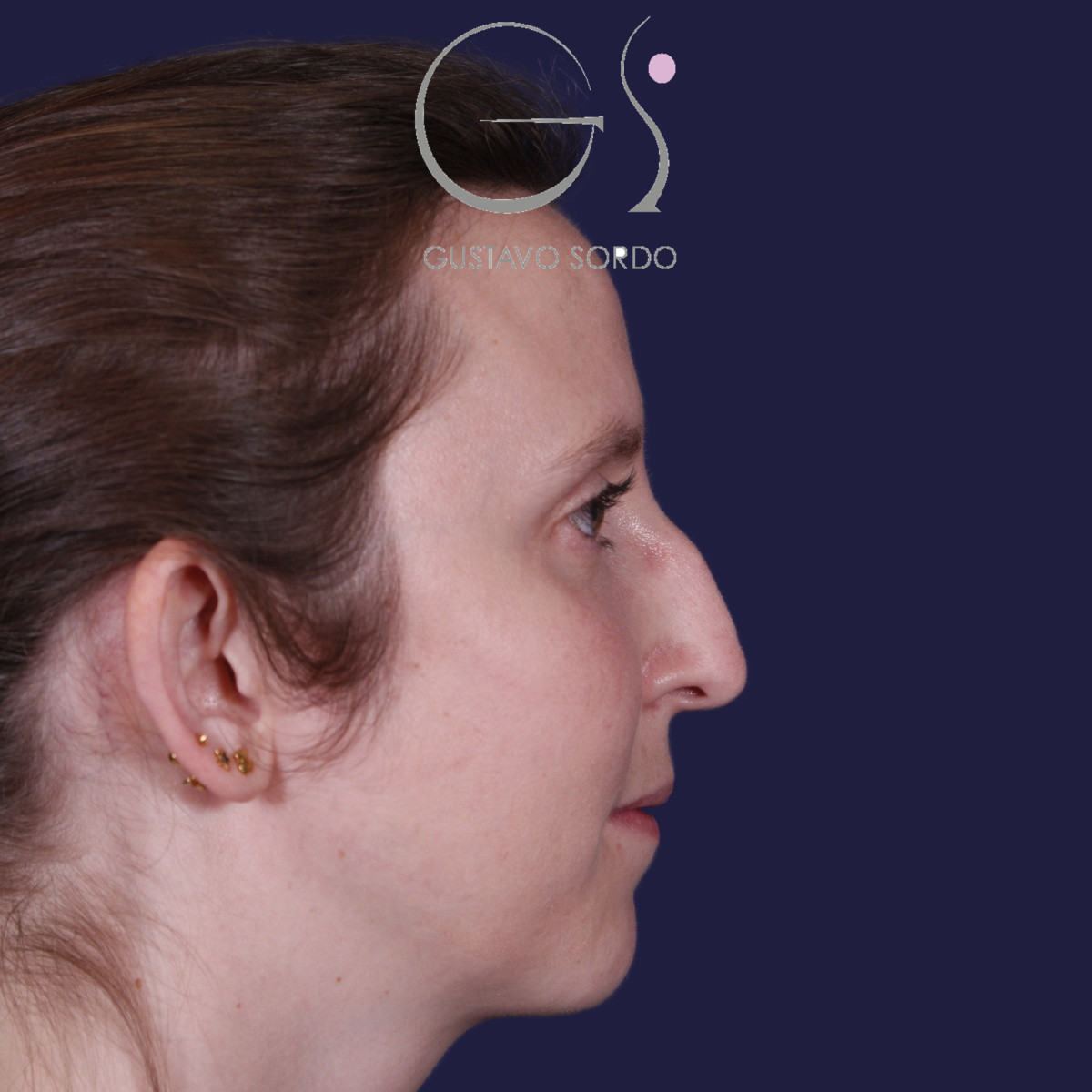 Rinoplastia ultrasónica realizada en paciente joven — antes. Caso operado por el Dr. Gustavo Sordo en Madrid