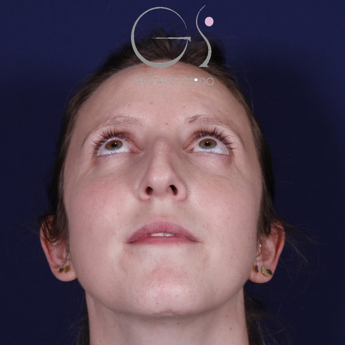 Rinoplastia ultrasónica realizada en paciente joven — antes. Caso operado por el Dr. Gustavo Sordo en Madrid