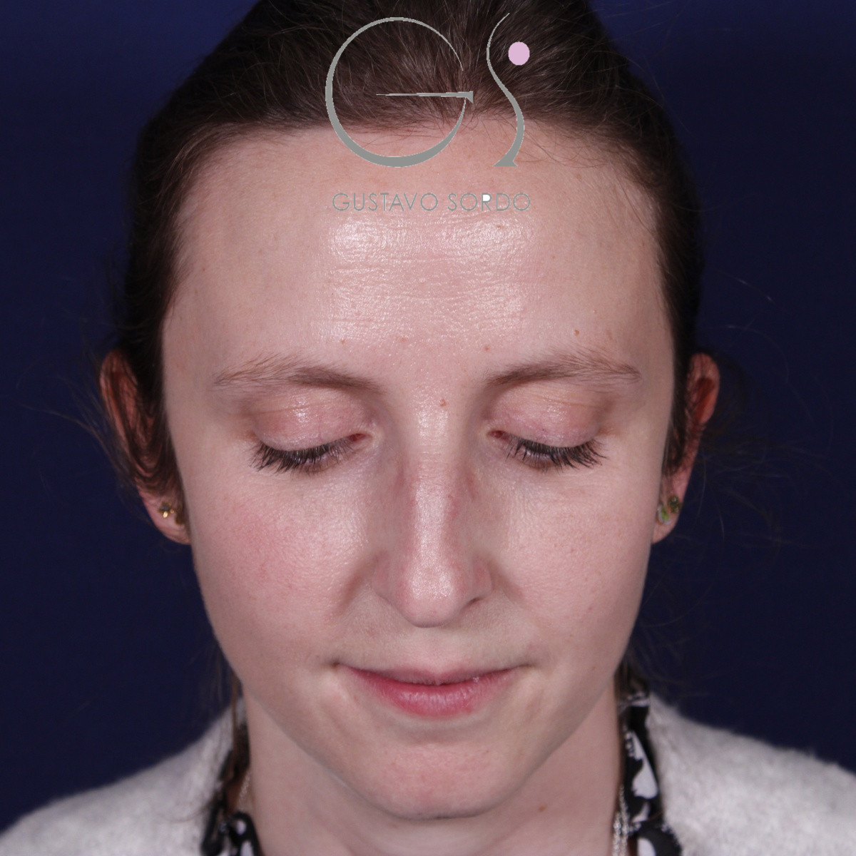 Rinoplastia ultrasónica realizada en paciente joven — antes. Caso operado por el Dr. Gustavo Sordo en Madrid